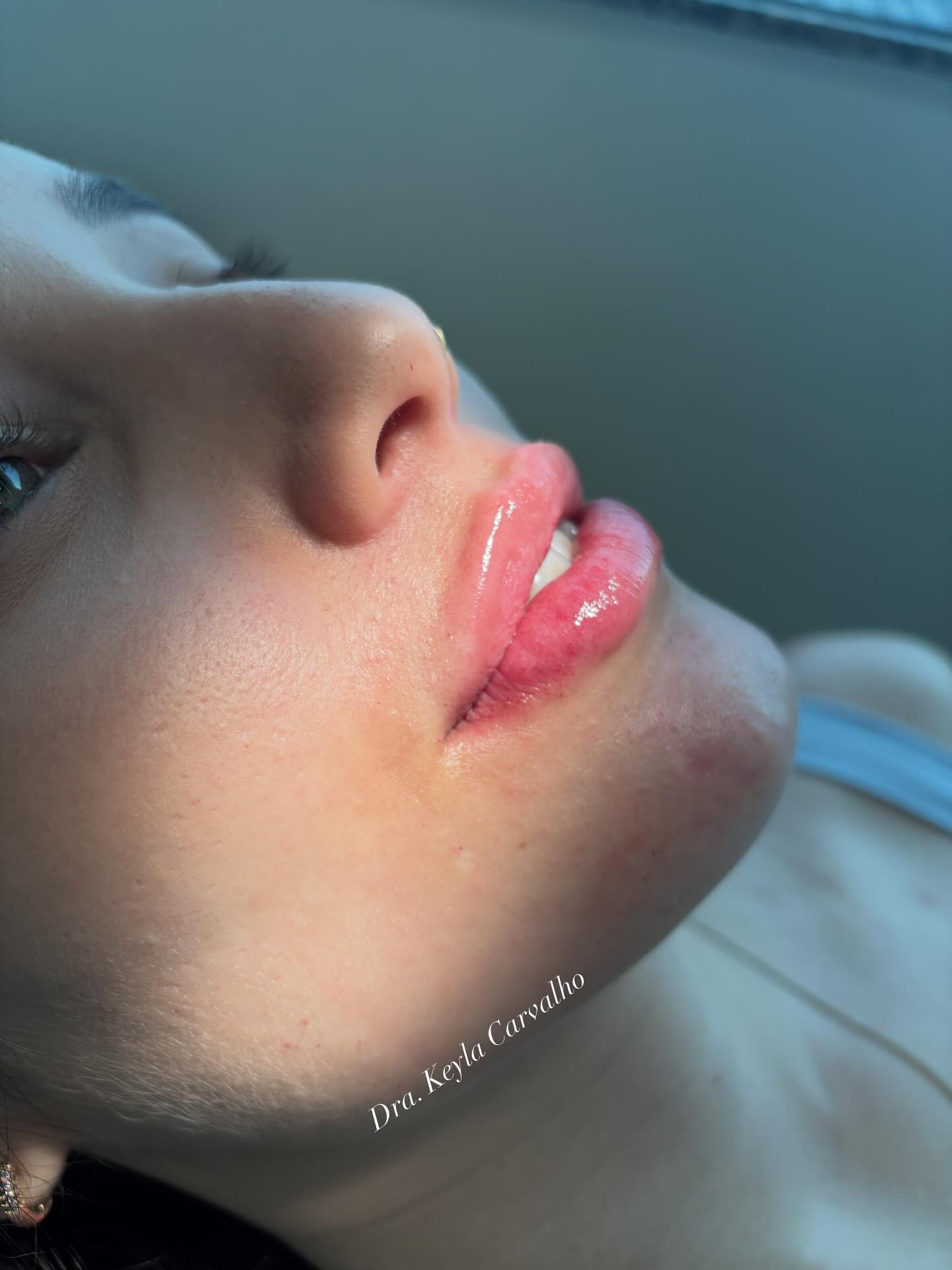 Dra. Keyla Carvalho — Harmonização Facial Natural